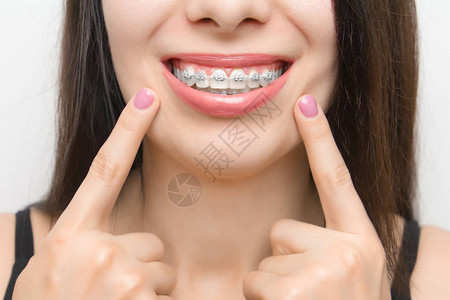美白后用两根手指放在牙齿上的支架上图片