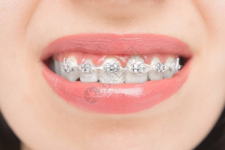 靠近牙套美白后牙齿上的支架带金属系带和灰色松紧带或橡皮筋的自锁式托槽图片