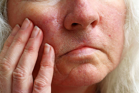 一名老年妇女脸上的红血管斑图片