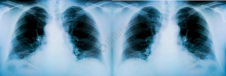 对病人肺部进行一系列X光检查并有明显发图片