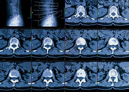 慢背部疼痛病人的类脊椎的计算机断层摄影或CT成像结果显示脊椎腰膜纤维化和神经根压缩的退化变单背景图片