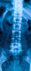 人体下腰椎部分骨骼的X光片图片