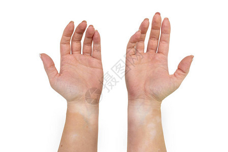 一位年轻的高加索妇女的手和前臂内部从维蒂利戈病中扎根图片