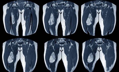 右大腿磁共振成像图片