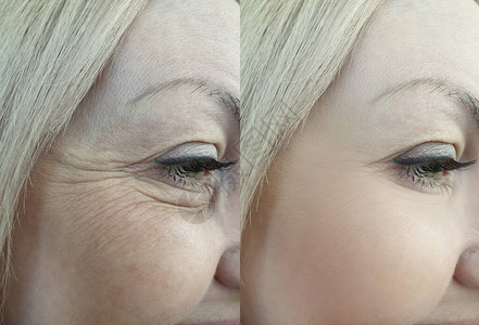 妇女在治疗前后眼睛皱纹图片