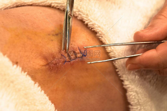 镊子用于去除腿部伤口的缝合线图片