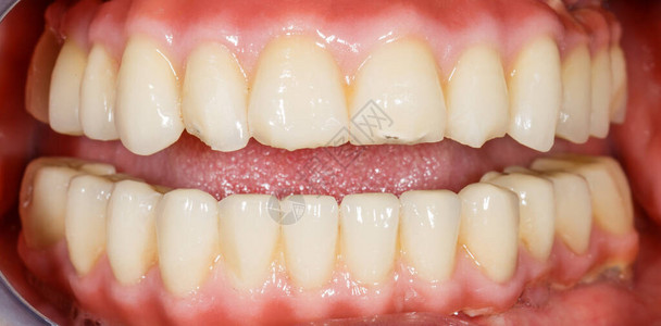 人嘴中瓷氧化锆牙的特写照片图片
