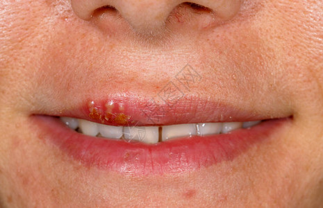 口腔单纯疱疹感染的特写照片图片