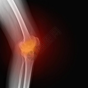患有风湿病的女膝盖真正的骨骼X光片类风湿关节炎膝痛医学概念医学诊断背景图片