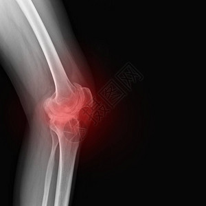 患有风湿病的女膝盖真正的骨骼X光片类风湿关节炎膝痛医学概念医学诊断图片
