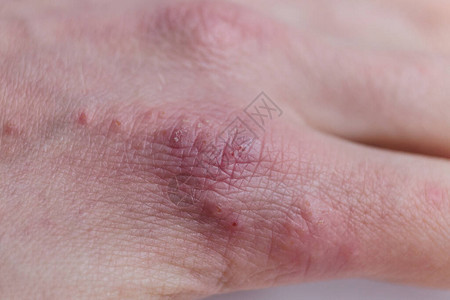 显示干皮肤斑块的病人手指缝合图片
