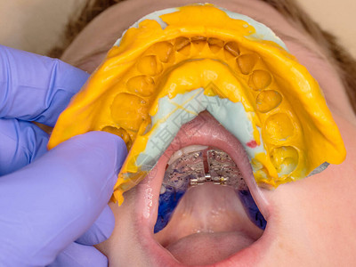 牙科医生使用牙印检查年轻病人的牙套近距图片