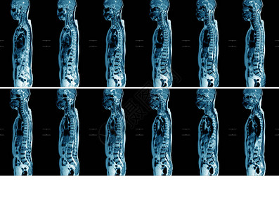 T1T10T12L2L3L5节段多发骨髓病灶增强高清图片
