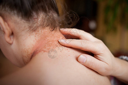 女用止痛药膏使背部皮肤图片