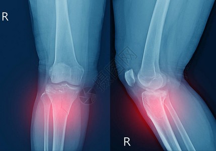 线膝关节胫骨近端干骺端骨折胫骨外侧平台凹陷骨折红点软组织严重肿胀背景图片