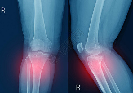 线膝关节胫骨近端干骺端骨折胫骨外侧平台凹陷骨折红点软组织严重肿胀背景图片