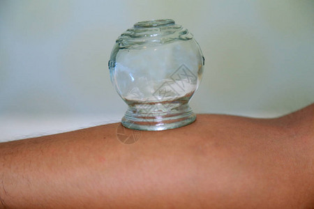 对患者背部进行真空拔罐治疗图片素材