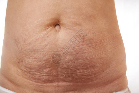 一个40岁的妇女腹部有产后伸图片