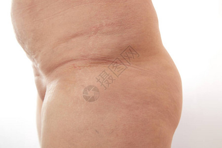 一个40岁的孕妇的腿部有产后伸图片
