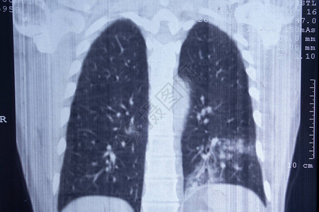 受影响的肺部X光片CT扫描图片