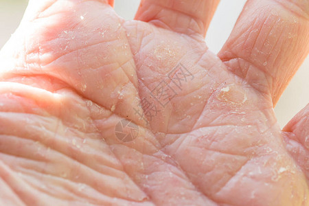 一个有鳞状皮肤的人手上的皮肤湿疹图片