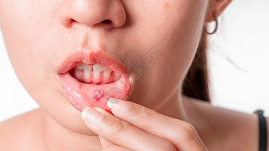疱疹性咽峡炎亚洲妇女有白种背景的口腔抽搐溃疡背景