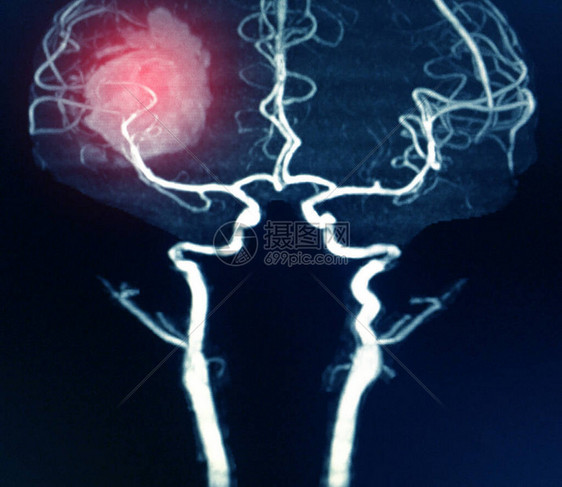 MRA大脑或出血中脑动脉的磁共振动脉图图片