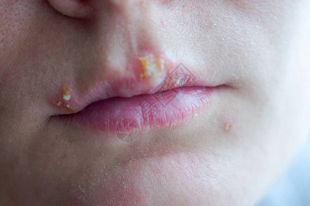 一个年轻女孩的嘴唇上有疹子病图片