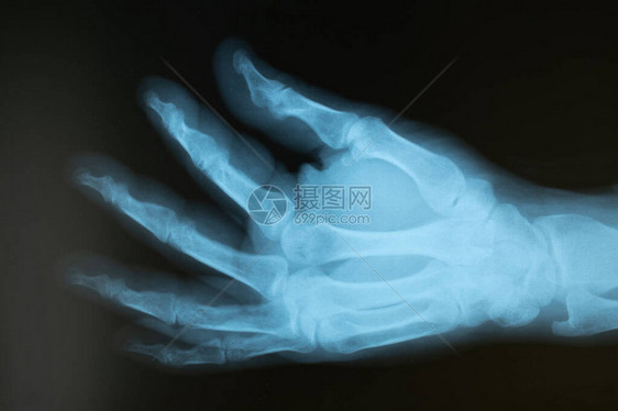 手指受伤的成年男手的X光片选择焦点模糊噪声清晰度和颗粒是射线的典型特图片