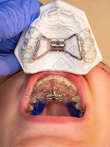 医生检查口腔的整形矫器牙修补方法Hyrax和图片