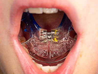 男孩在他的舌头上展示带有不锈钢丝的丙烯酸牙套在儿童牙齿上设置临时牙套男孩微笑的嘴背景图片