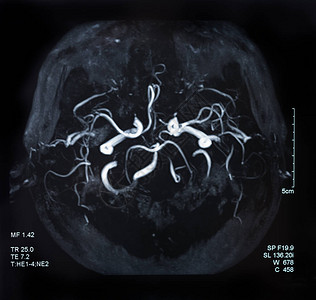 脑中风和脑血管疾病磁共振成像图片