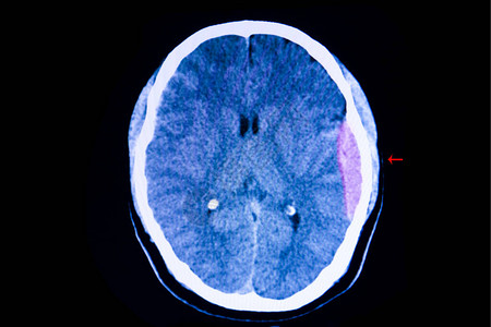 对交通事故病人的脑部进行CT扫描图片