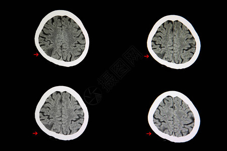 脑梗死病人的脑部CT扫描显示右对子区域有微弱的皮图片