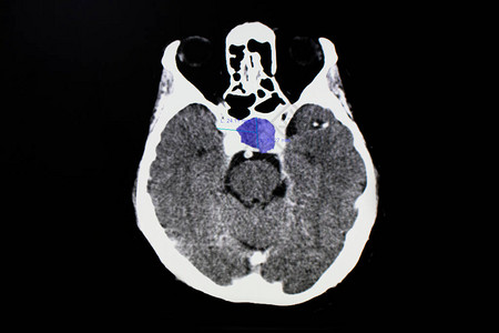 垂体瘤患者的CT脑部扫描显示垂体窝内有异质肿块垂体腺瘤和中图片