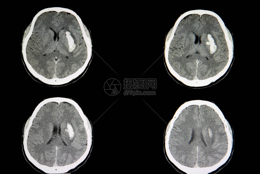 出血中风导致颅内大出血患者的大脑CT扫描左侧大脑图片
