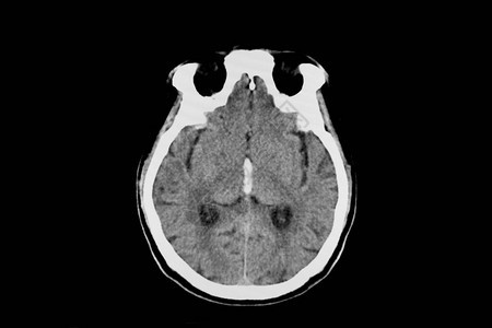 脑部内出血的病人的脑部CT扫描在第三根心室中图片