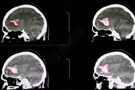 在右前方有大血凝块的血栓状脑部脑部CT扫描从腹腔图片