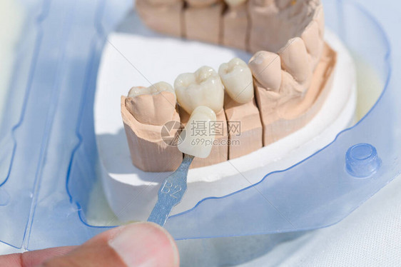 用sha检查牙冠或植入物的单板图片