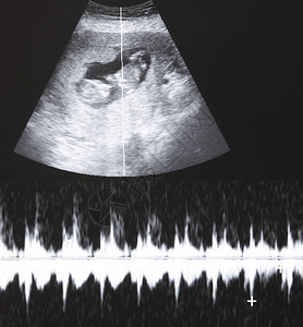 胎儿超声与心跳图图片