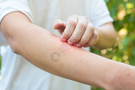 人体在户外被昆虫咬从过敏皮肤疹中痒图片