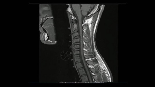 子宫颈脊椎表层T1加权图像MRI宫颈脊椎显示轻盘病图片
