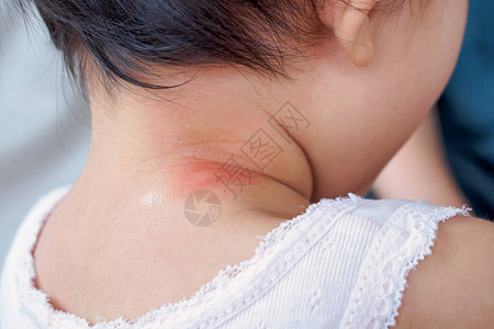 紅點婴儿皮肤疹和过敏因被蚊子咬脖子而背景