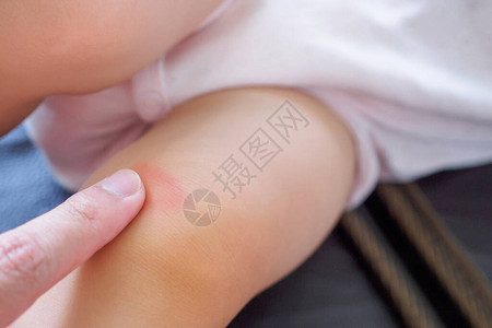 母亲在婴儿膝盖上用抗过敏乳霜图片