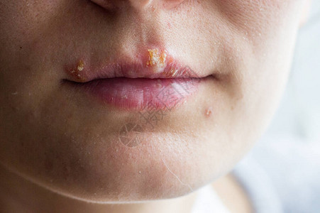 一个年轻女孩的嘴唇上有疹子病图片