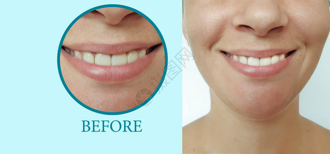 牙齿美白手术前后微笑的女人图片