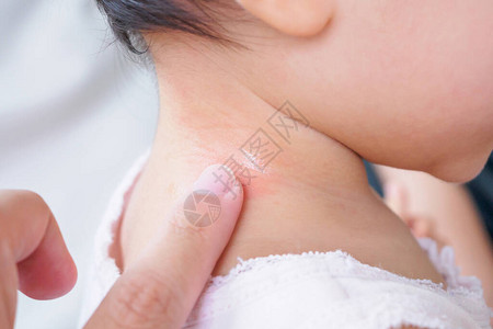 母亲在婴儿脖子上施抗过敏乳霜图片