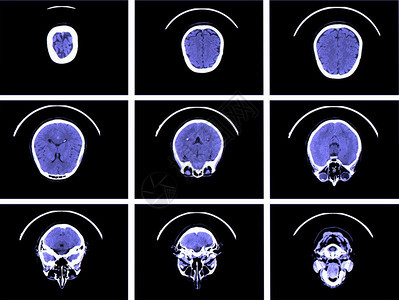 大脑计算机断层扫描的X射线图像背景图片