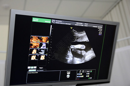怀孕妇腹部超声波屏幕图片