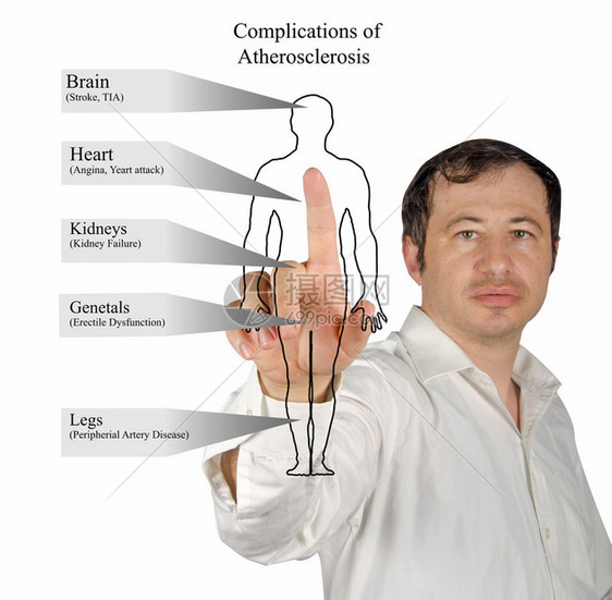 Atherrosc硬化图片